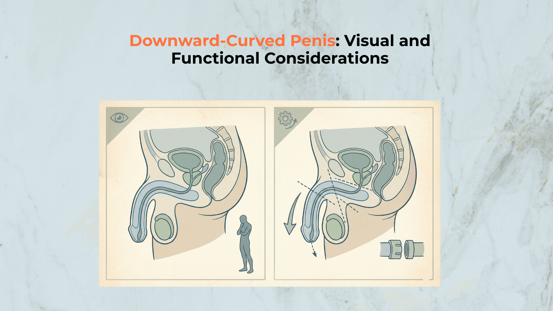 Downward Curved Penis Visual And Functional Considerations