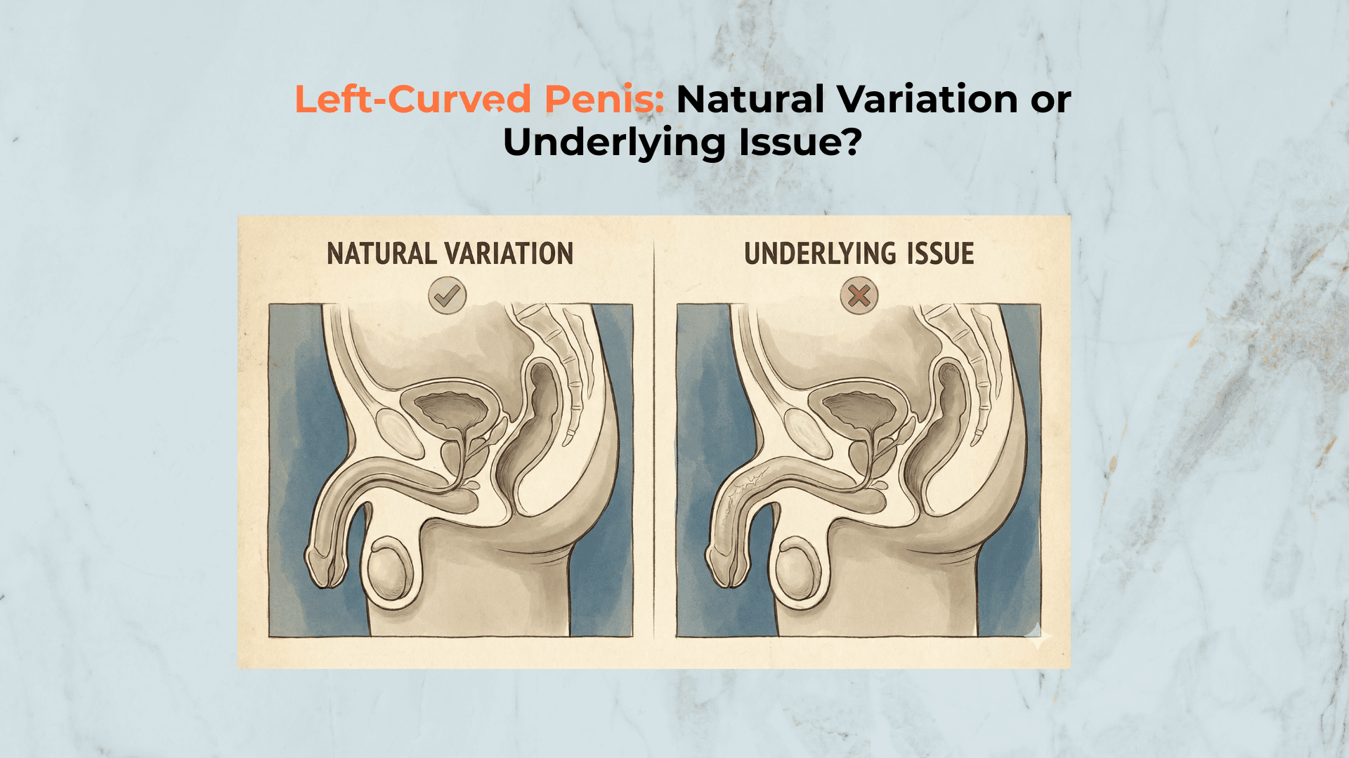 Left-Curved Penis: Natural Variation or Underlying Issue?