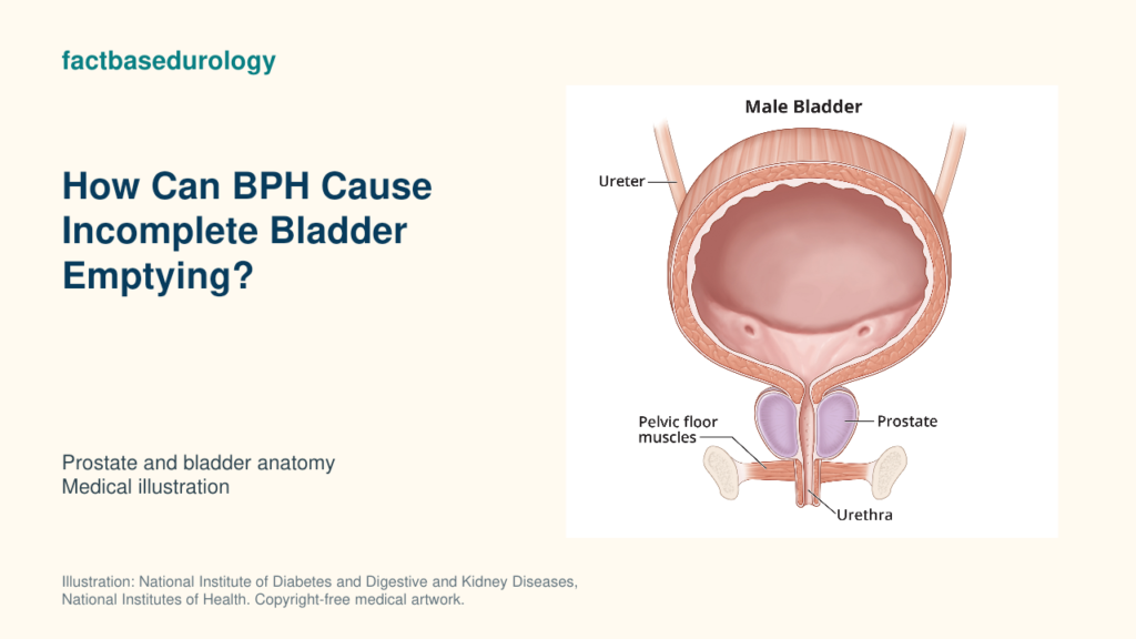 How Can BPH Cause Incomplete Bladder Emptying? Obstruction and Post-Void Residual 21 How Can BPH Cause Incomplete Bladder Emptying? — prostate and bladder anatomy (medical illustration).
