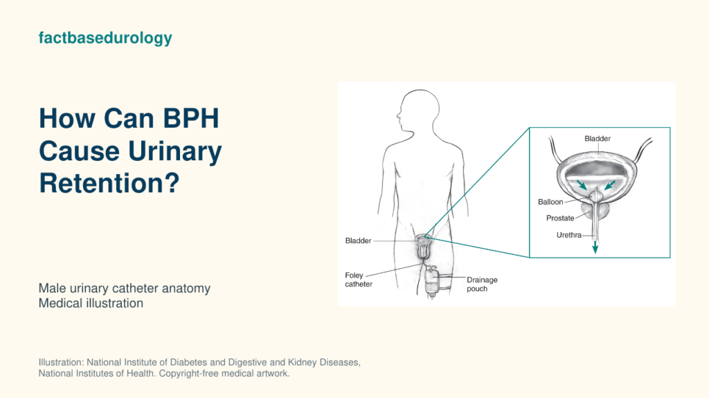 How Can BPH Cause Urinary Retention? Acute and Chronic Bladder Outlet Obstruction 23 How Can BPH Cause Urinary Retention? — male urinary catheter anatomy (medical illustration).
