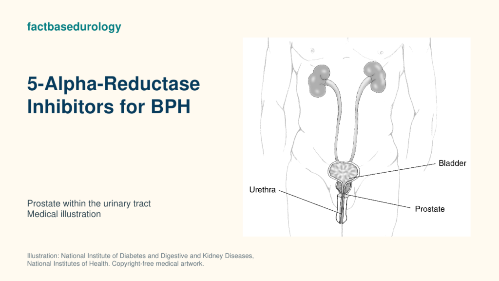 5-Alpha-Reductase Inhibitors for BPH: Prostate Shrinkage, PSA Effects and Candidates 1 5-Alpha-Reductase Inhibitors for BPH — prostate within the urinary tract (medical illustration).