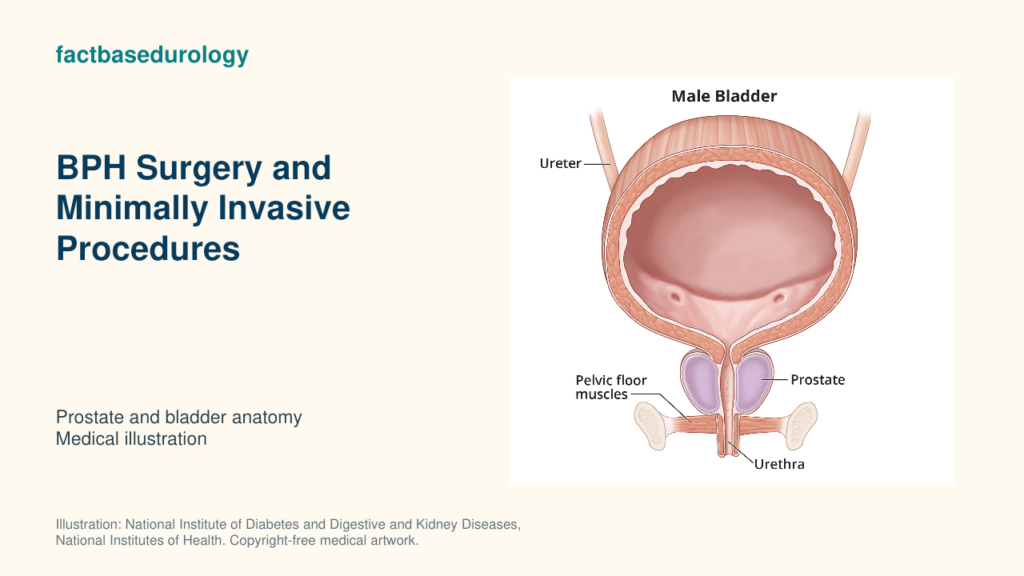 BPH Surgery and Minimally Invasive Procedures — prostate and bladder anatomy (medical illustration).