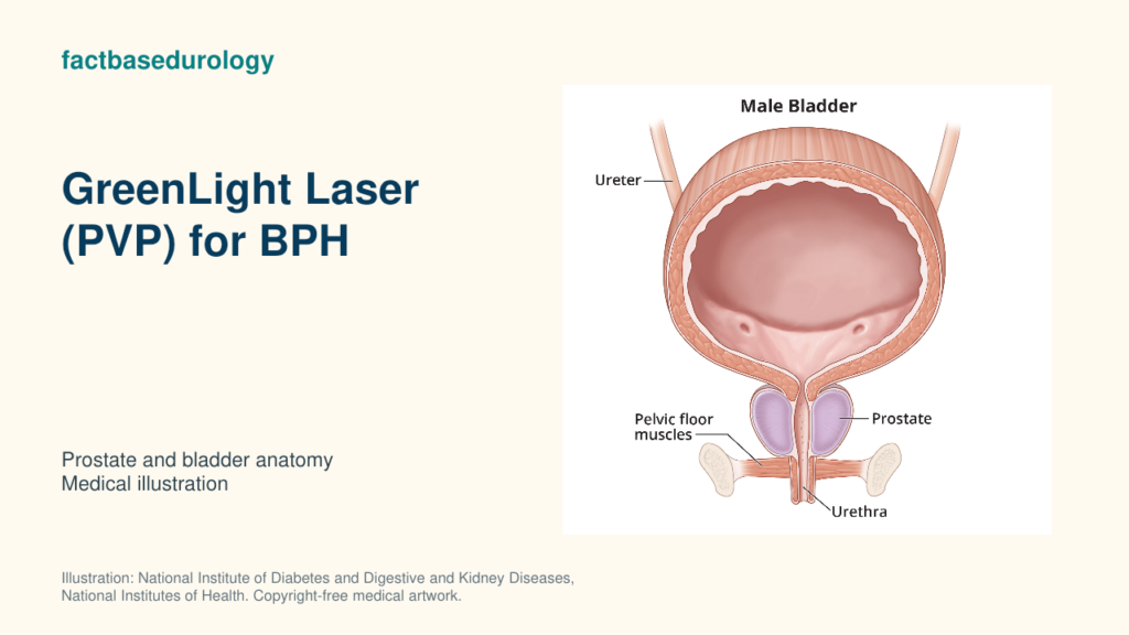 GreenLight Laser (PVP) for BPH — prostate and bladder anatomy (medical illustration).