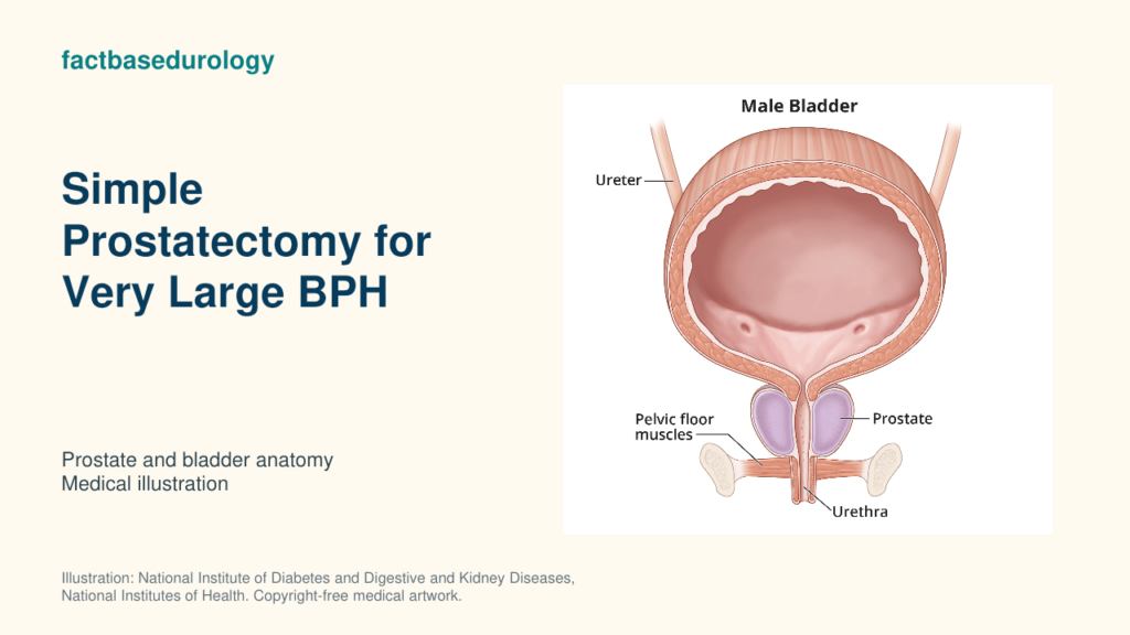 Simple Prostatectomy for Very Large BPH — prostate and bladder anatomy (medical illustration).