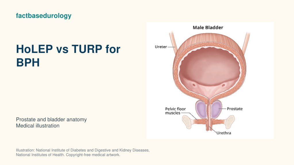 HoLEP vs TURP for BPH — prostate and bladder anatomy (medical illustration).