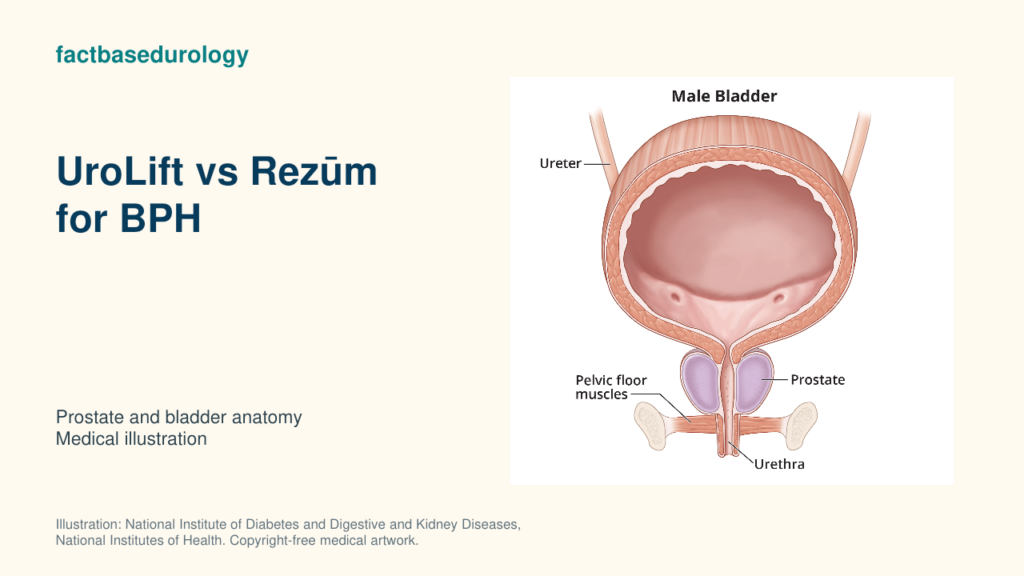 UroLift vs Rezūm for BPH — prostate and bladder anatomy (medical illustration).