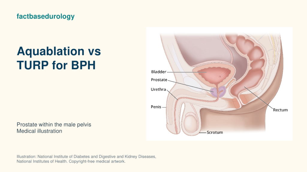 Aquablation vs TURP for BPH — prostate within the male pelvis (medical illustration).