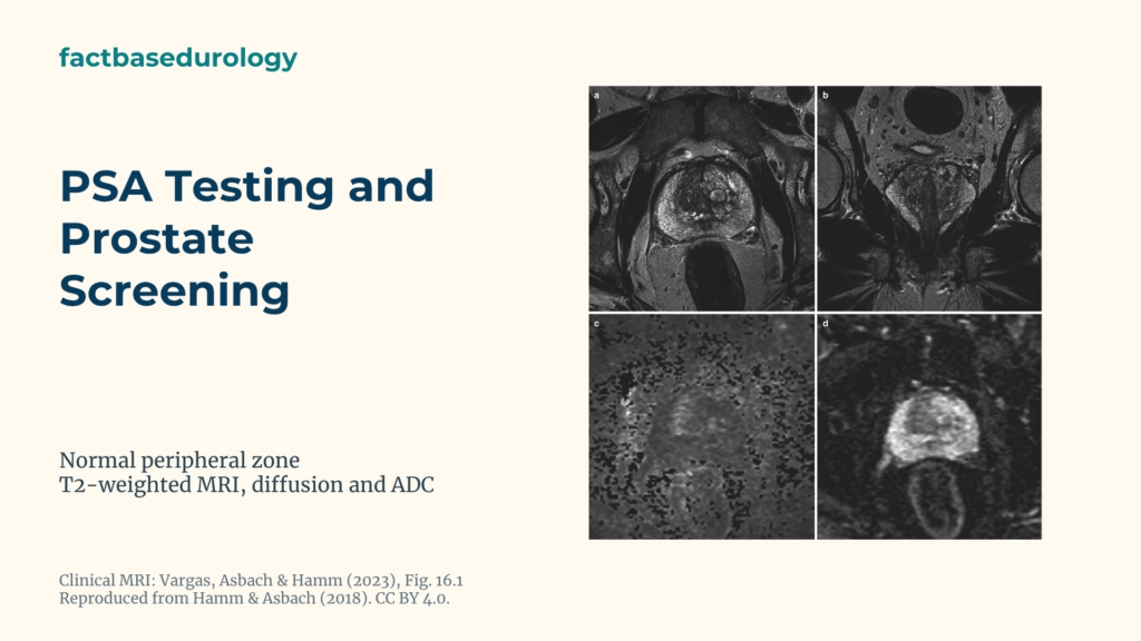 PSA Testing and Prostate Screening: Levels, Risk, MRI, Biopsy and Follow-Up 3 PSA Testing and Prostate Screening Featured cover with Normal prostate peripheral zone on T2-weighted, diffusion-weighted MRI and an ADC map.
