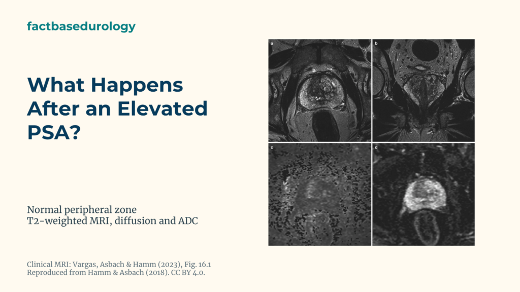 What Happens After an Elevated PSA? Repeat Testing, Risk Assessment, MRI and Biopsy 1 What Happens After an Elevated PSA? Featured cover with Normal prostate peripheral zone on T2-weighted, diffusion-weighted MRI and an ADC map.