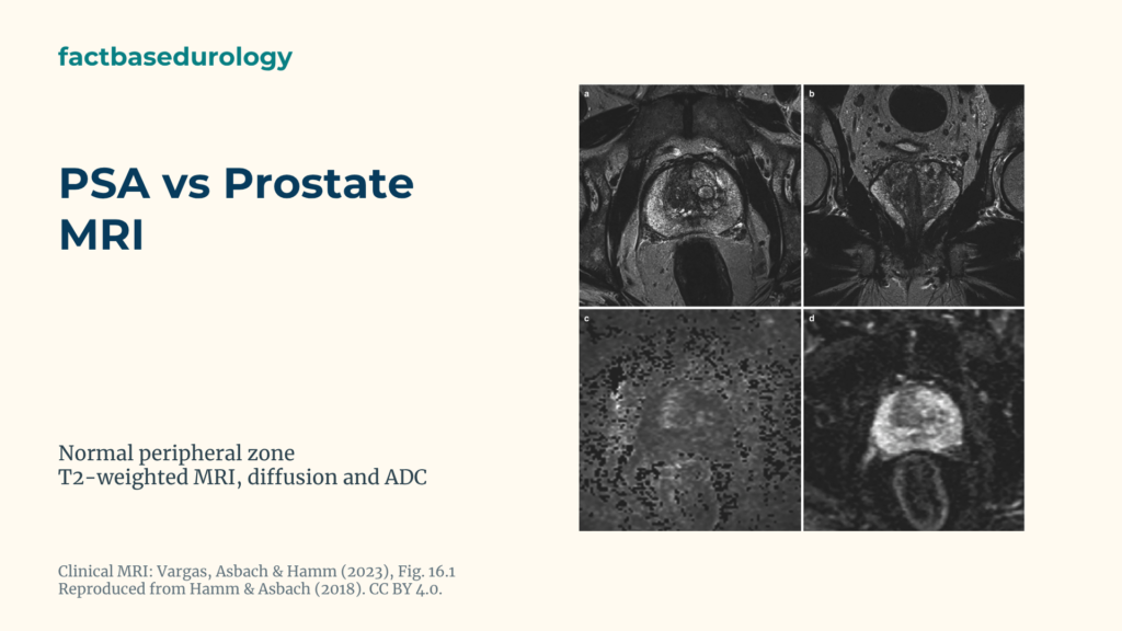PSA vs Prostate MRI: Biomarker Testing vs Imaging in Cancer Risk Assessment 3 PSA vs Prostate MRI Featured cover with Normal prostate peripheral zone on T2-weighted, diffusion-weighted MRI and an ADC map.