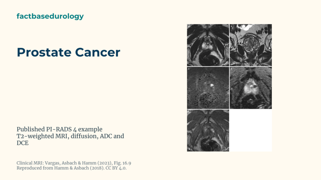 Prostate Cancer Featured cover with An 11 mm PI-RADS 4 lesion in the left lateral prostate peripheral zone on T2, diffusion, ADC and contrast MRI.