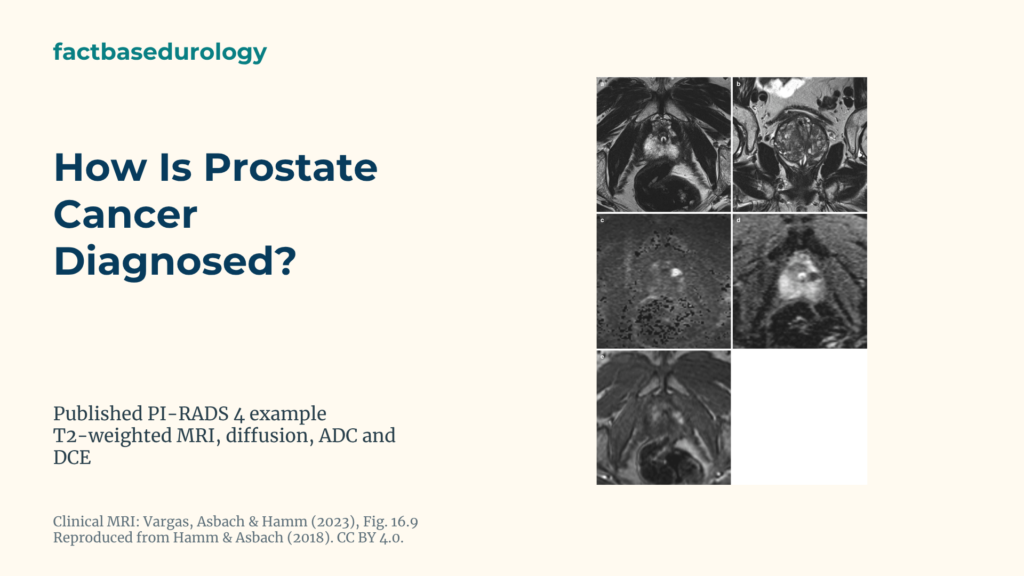 How Is Prostate Cancer Diagnosed? Featured cover with An 11 mm PI-RADS 4 lesion in the left lateral prostate peripheral zone on T2, diffusion, ADC and contrast MRI.