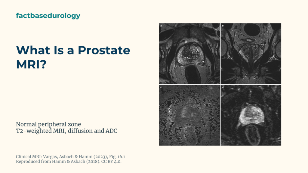 What Is a Prostate MRI? Featured cover with Normal prostate peripheral zone on T2-weighted, diffusion-weighted MRI and an ADC map.