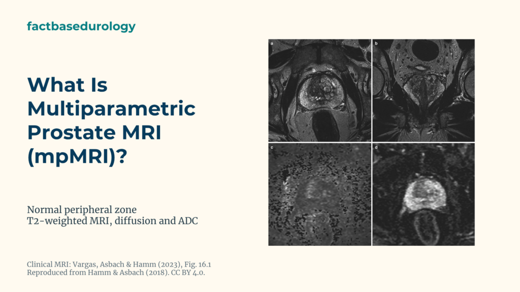 What Is Multiparametric Prostate MRI (mpMRI)? Featured cover with Normal prostate peripheral zone on T2-weighted, diffusion-weighted MRI and an ADC map.