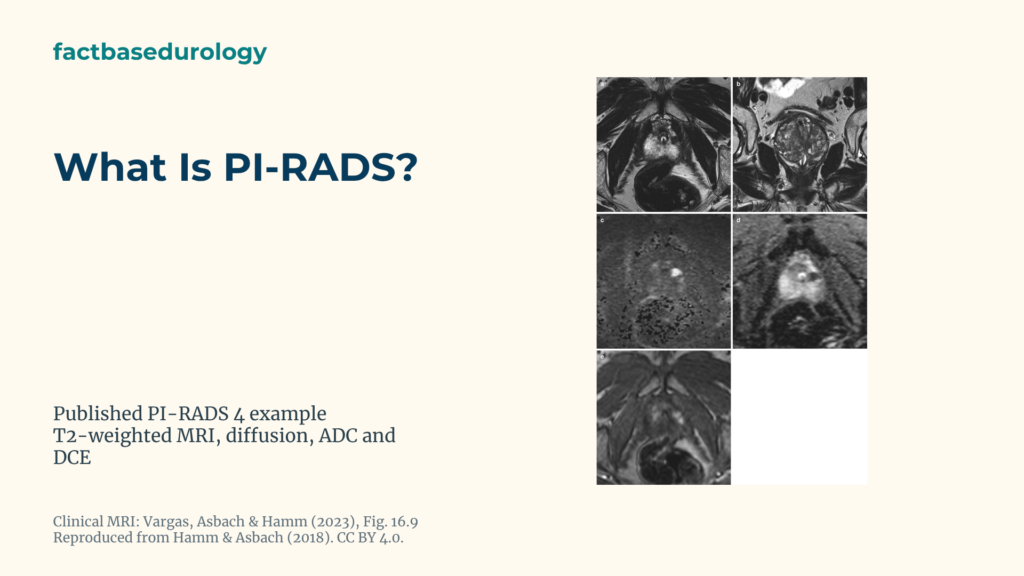 What Is PI-RADS? Featured cover with An 11 mm PI-RADS 4 lesion in the left lateral prostate peripheral zone on T2, diffusion, ADC and contrast MRI.