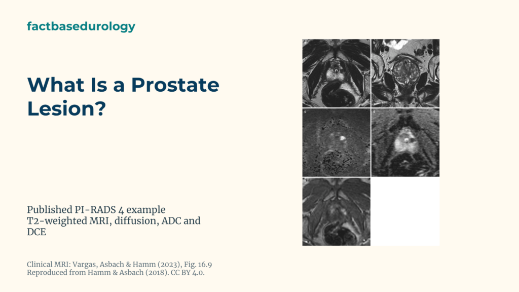 What Is a Prostate Lesion? Featured cover with An 11 mm PI-RADS 4 lesion in the left lateral prostate peripheral zone on T2, diffusion, ADC and contrast MRI.