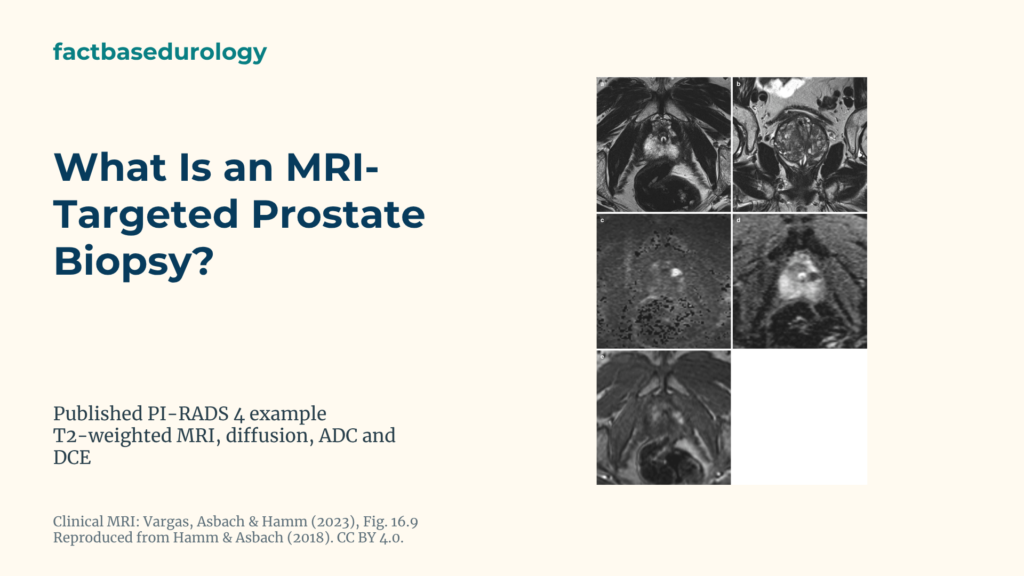 What Is an MRI-Targeted Prostate Biopsy? Lesion Targeting and Systematic Sampling 1 What Is an MRI-Targeted Prostate Biopsy? Featured cover with An 11 mm PI-RADS 4 lesion in the left lateral prostate peripheral zone on T2, diffusion, ADC and contrast MRI.