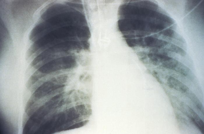 Can Hantavirus Shrink Your Penis? 2 Chest X-ray associated with hantavirus pulmonary syndrome